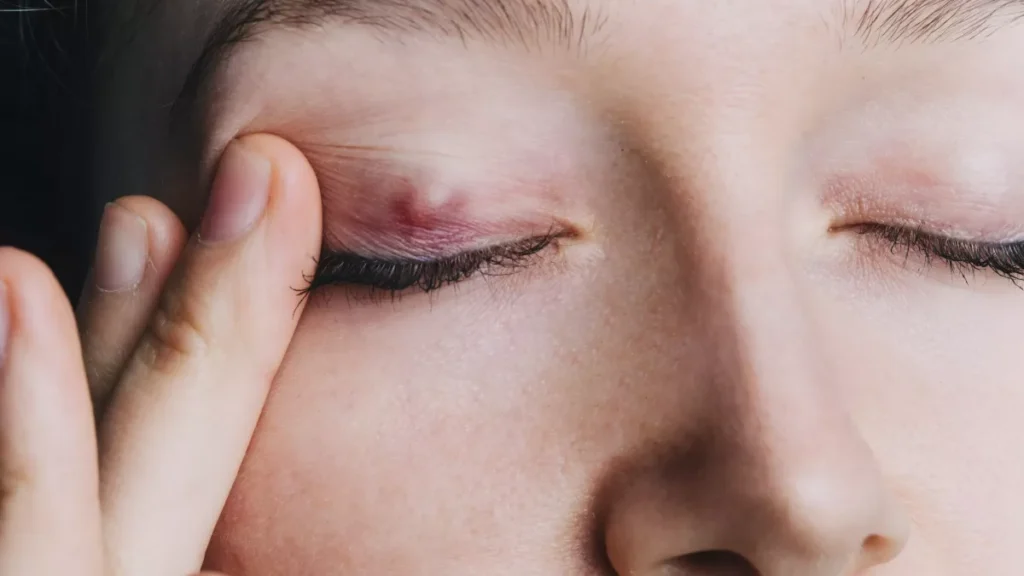 Peau qui pousse sur l&rsquo;œil : causes et traitements possibles